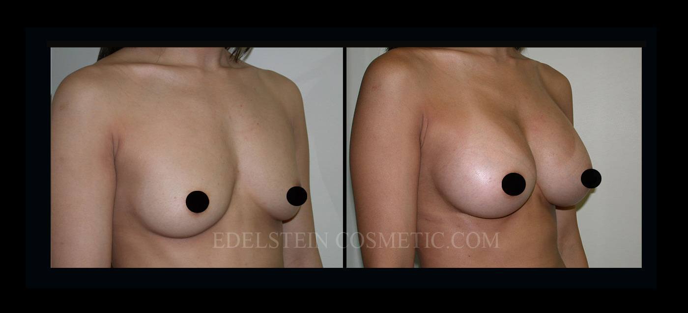 Breast Augmentation case #26863