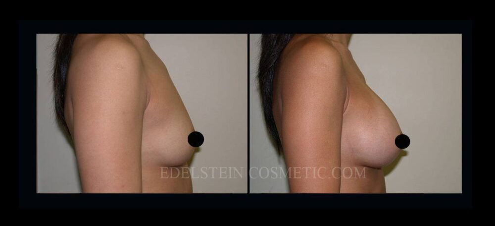 Breast Augmentation case #26863