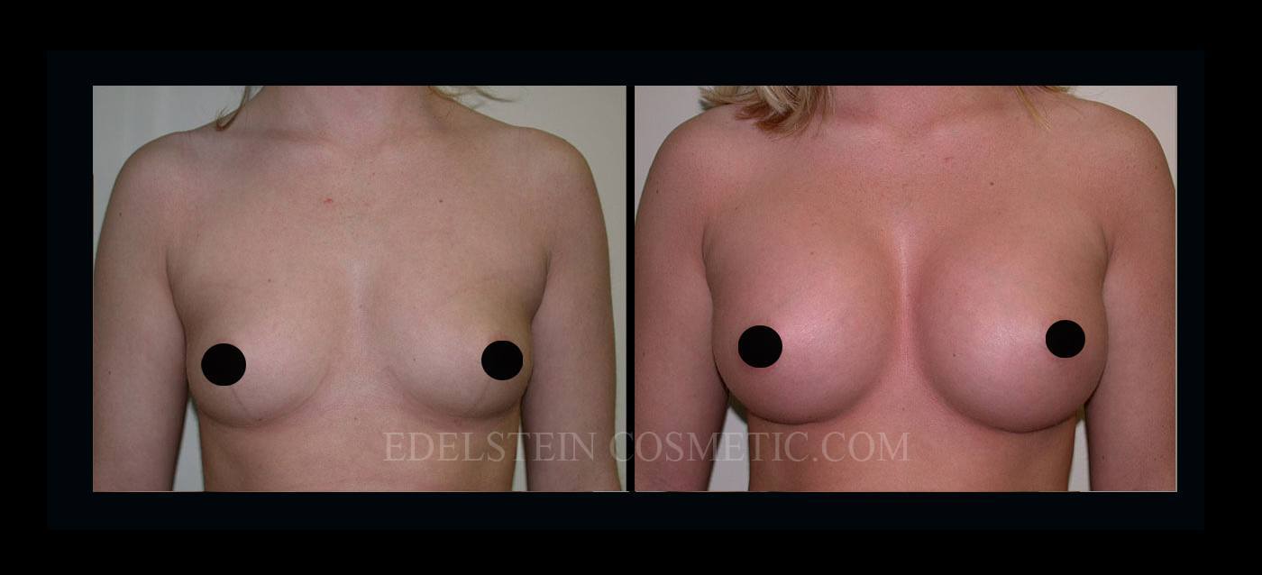 Breast Augmentation case #26862