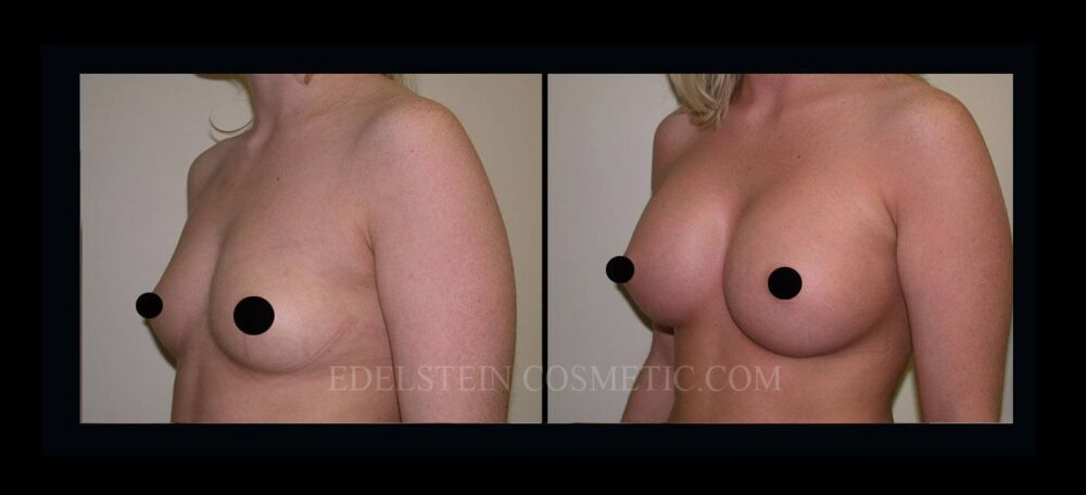 Breast Augmentation case #26862