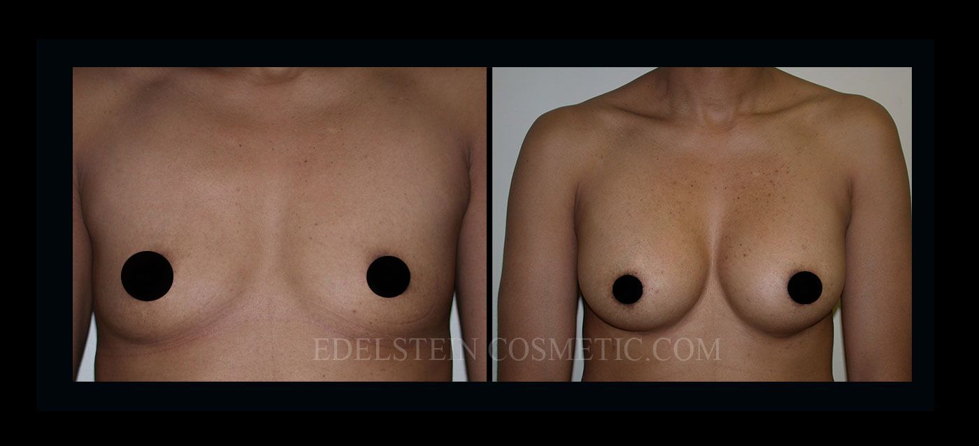 Breast Augmentation case #26861