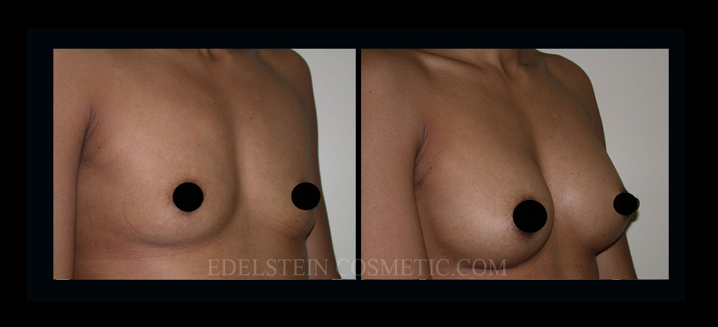 Breast Augmentation case #26861