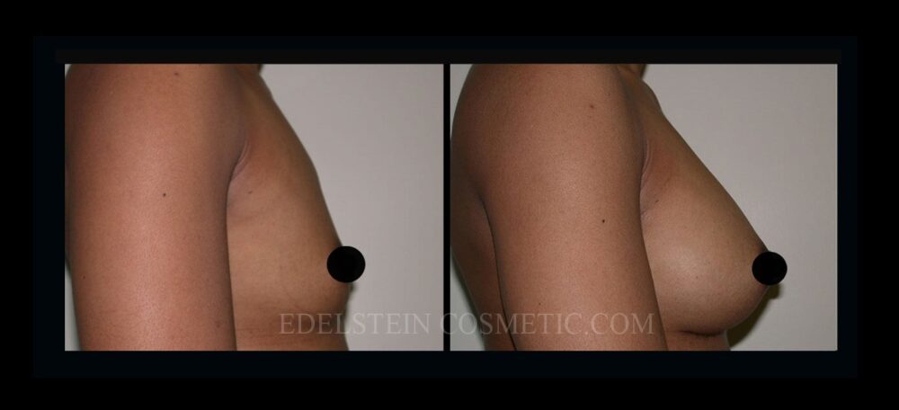 Breast Augmentation case #26861