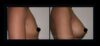 Breast Augmentation case #26861 slider thumbnail