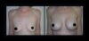 Breast Augmentation case #26860 slider thumbnail