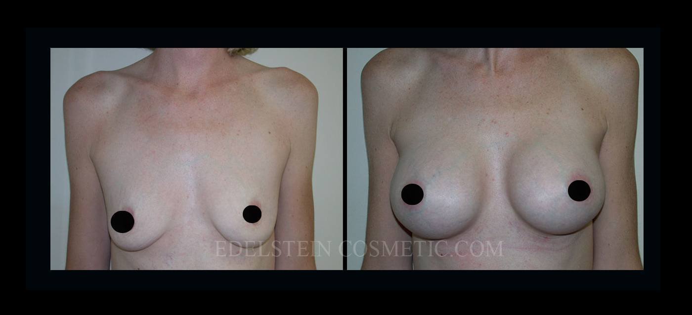 Breast Augmentation case #26860