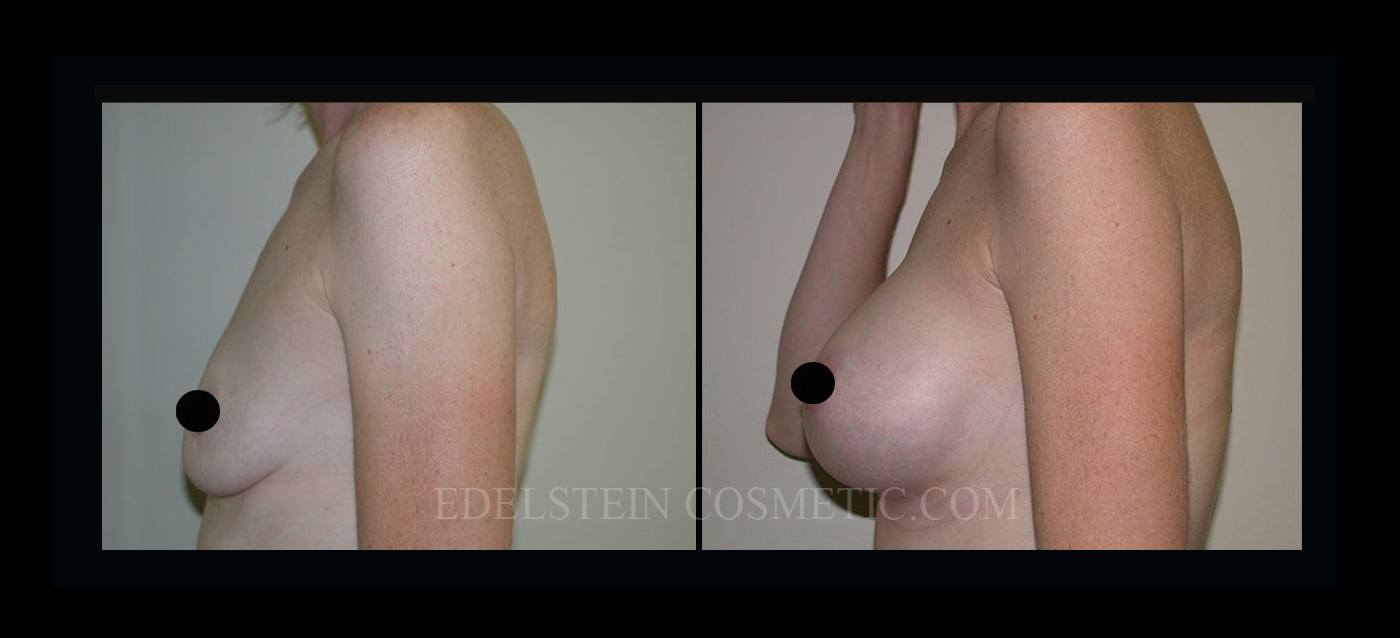 Breast Augmentation case #26860