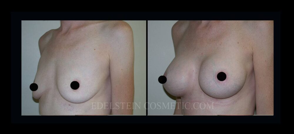 Breast Augmentation case #26860