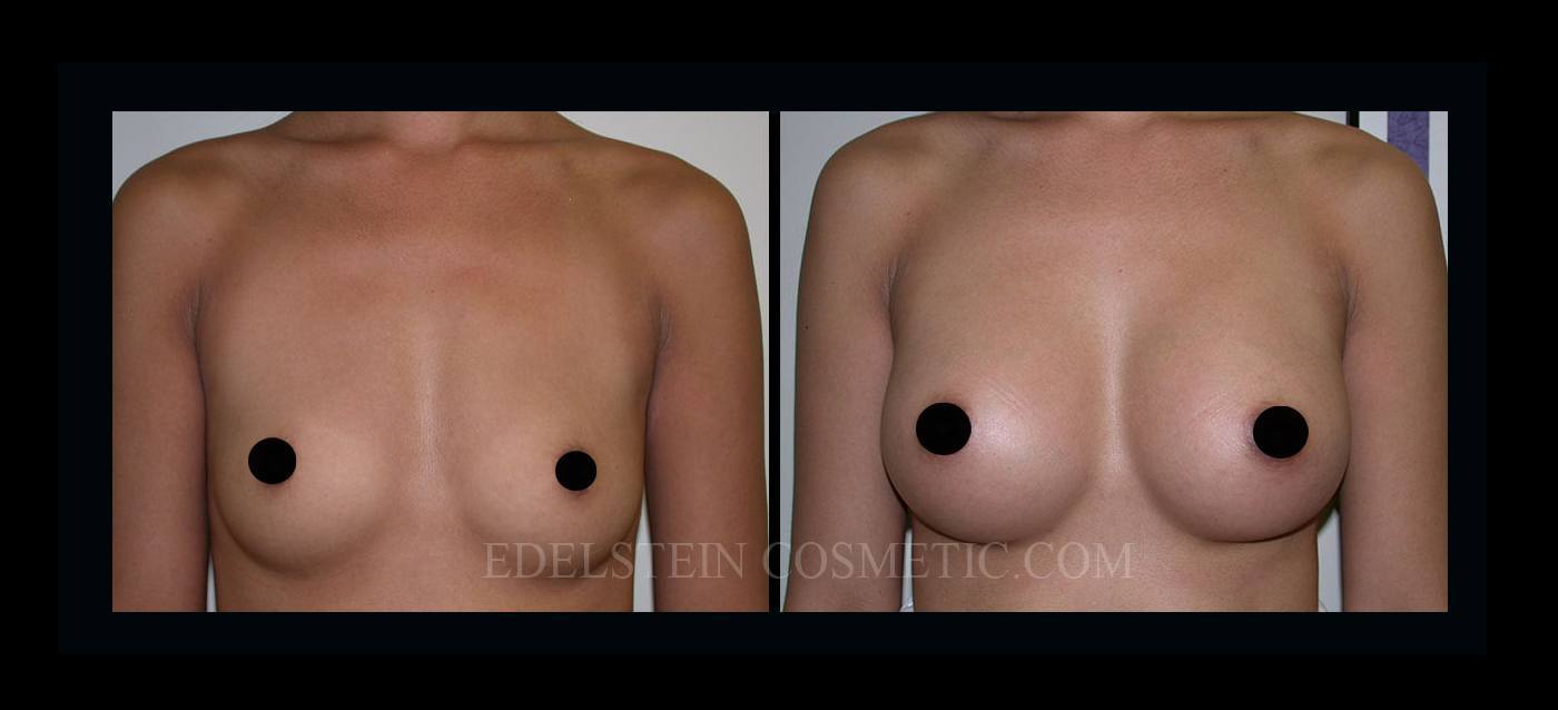 Breast Augmentation case #26859