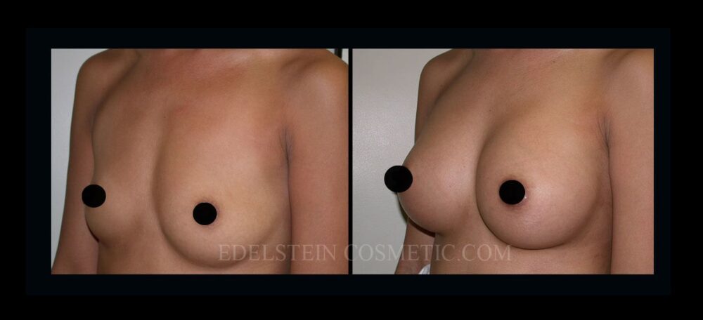 Breast Augmentation case #26859