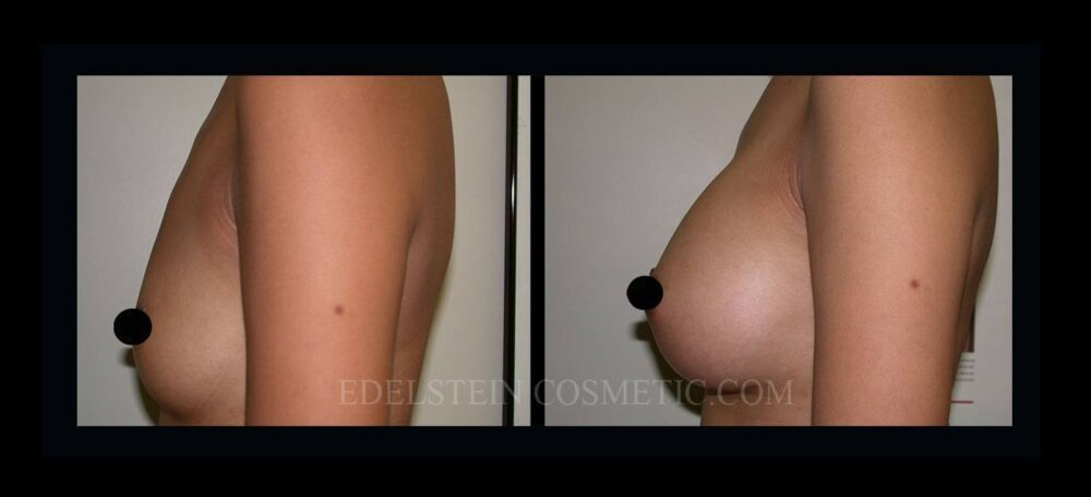 Breast Augmentation case #26859