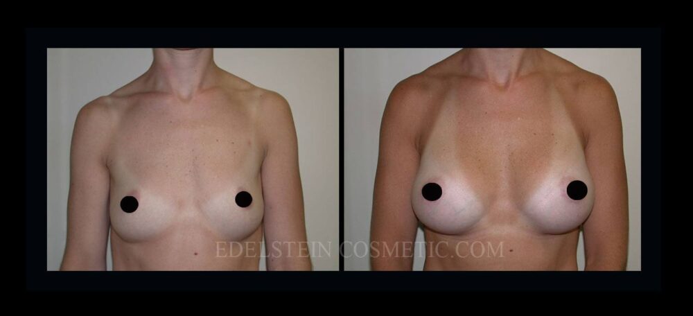 Breast Augmentation case #26858