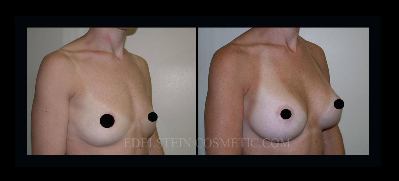 Breast Augmentation case #26858