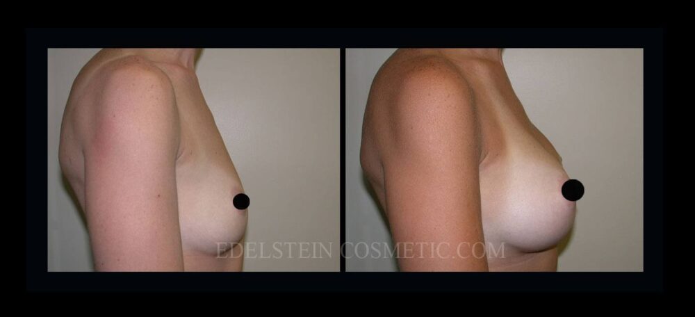 Breast Augmentation case #26858