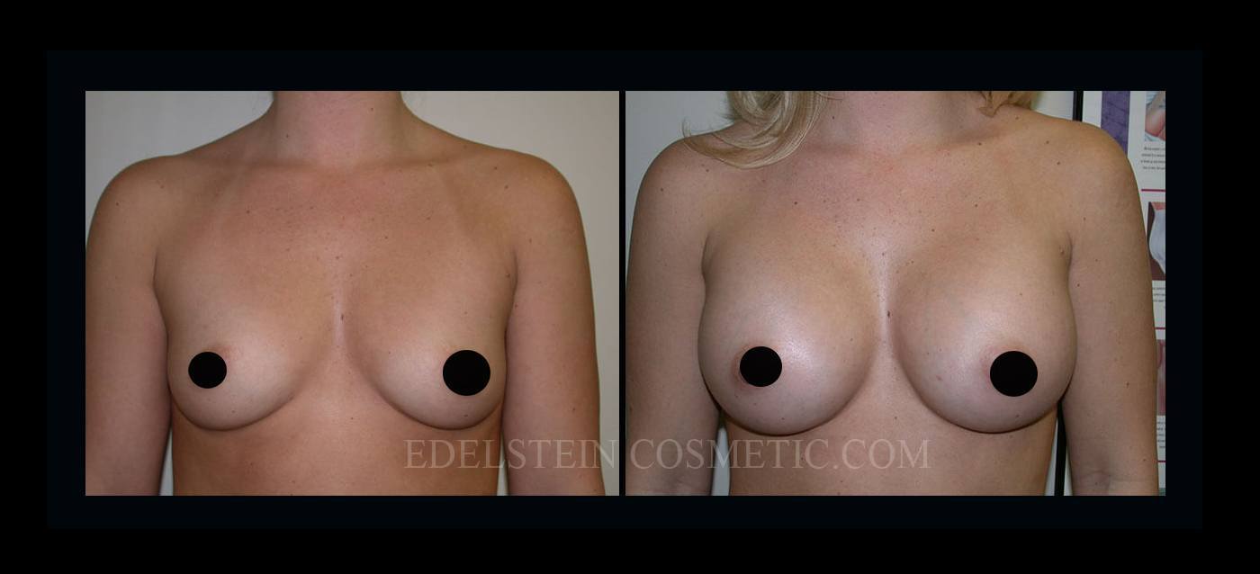 Breast Augmentation case #26857