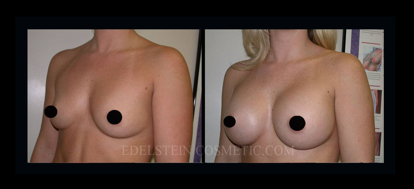 Breast Augmentation case #26857