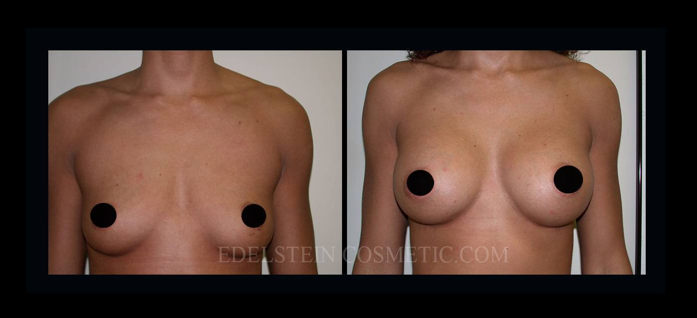 Breast Augmentation case #26856