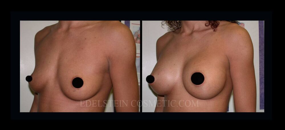 Breast Augmentation case #26856