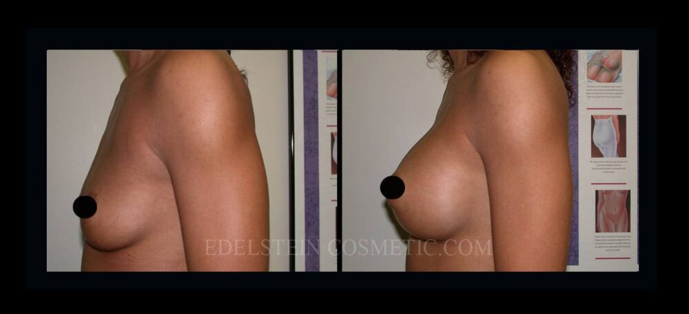 Breast Augmentation case #26856