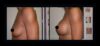 Breast Augmentation case #26856 slider thumbnail