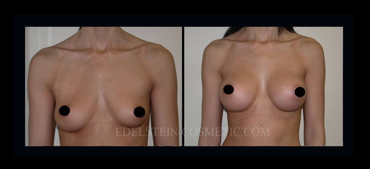 Breast Augmentation case #26855
