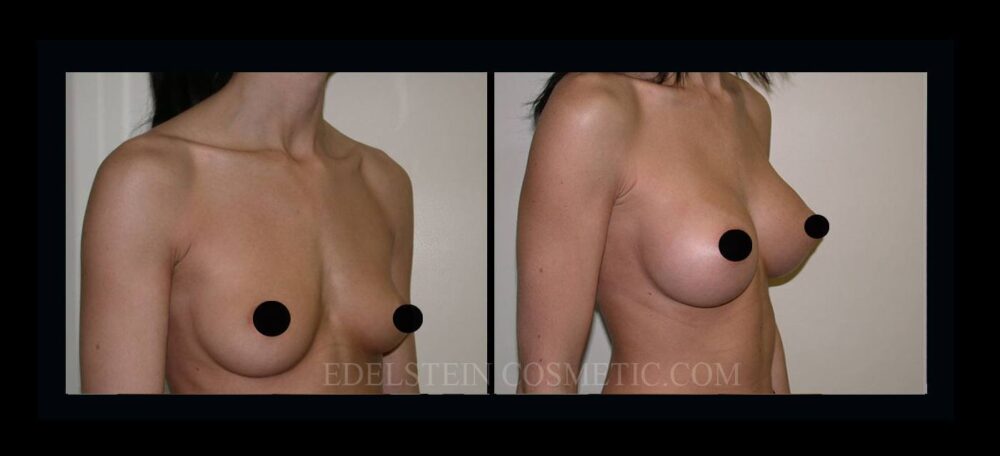 Breast Augmentation case #26855