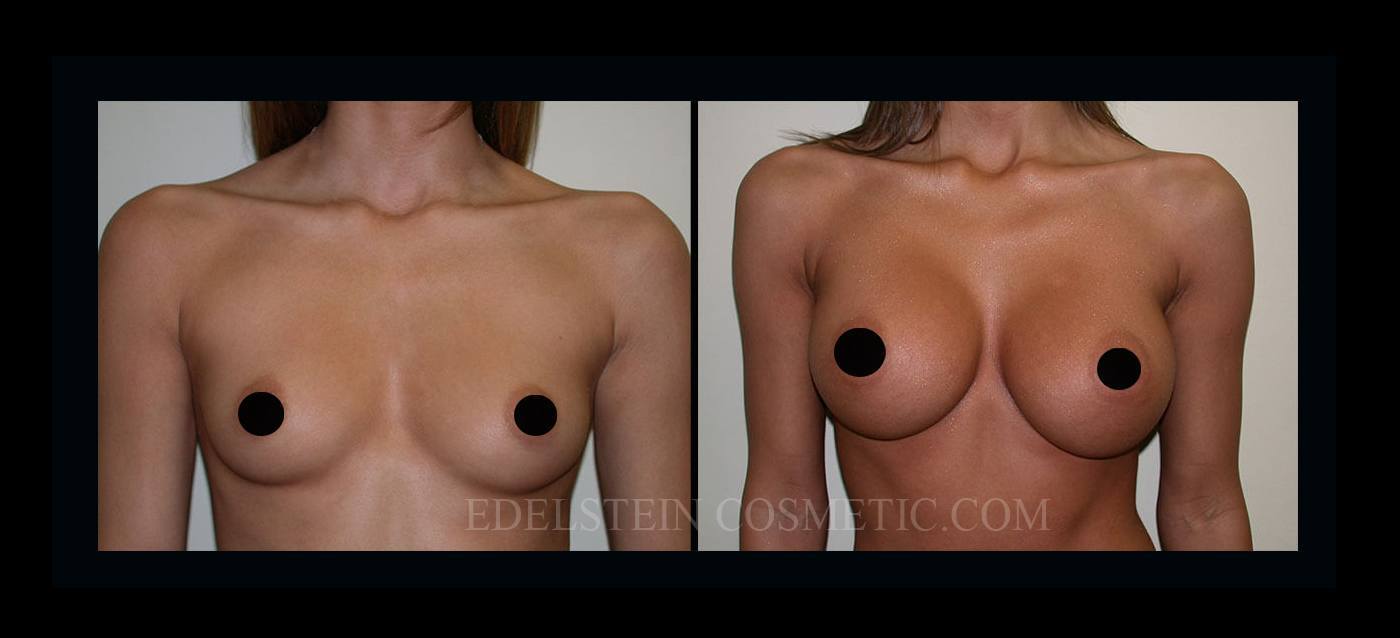 Breast Augmentation case #26853