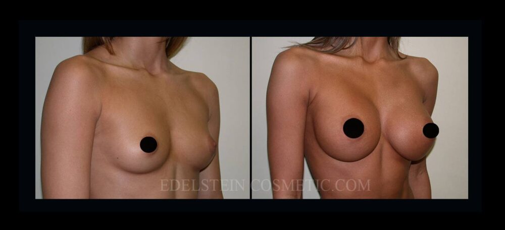 Breast Augmentation case #26853