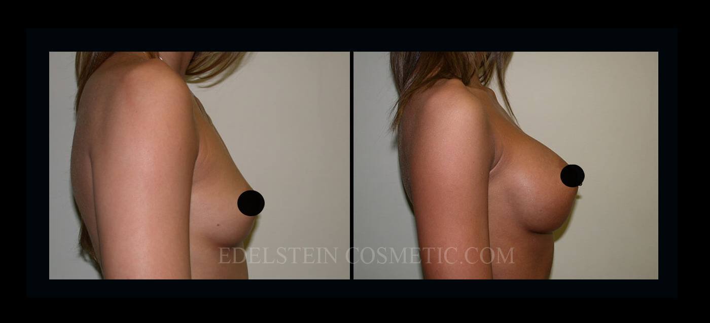 Breast Augmentation case #26853