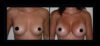 Breast Augmentation case #26852 slider thumbnail