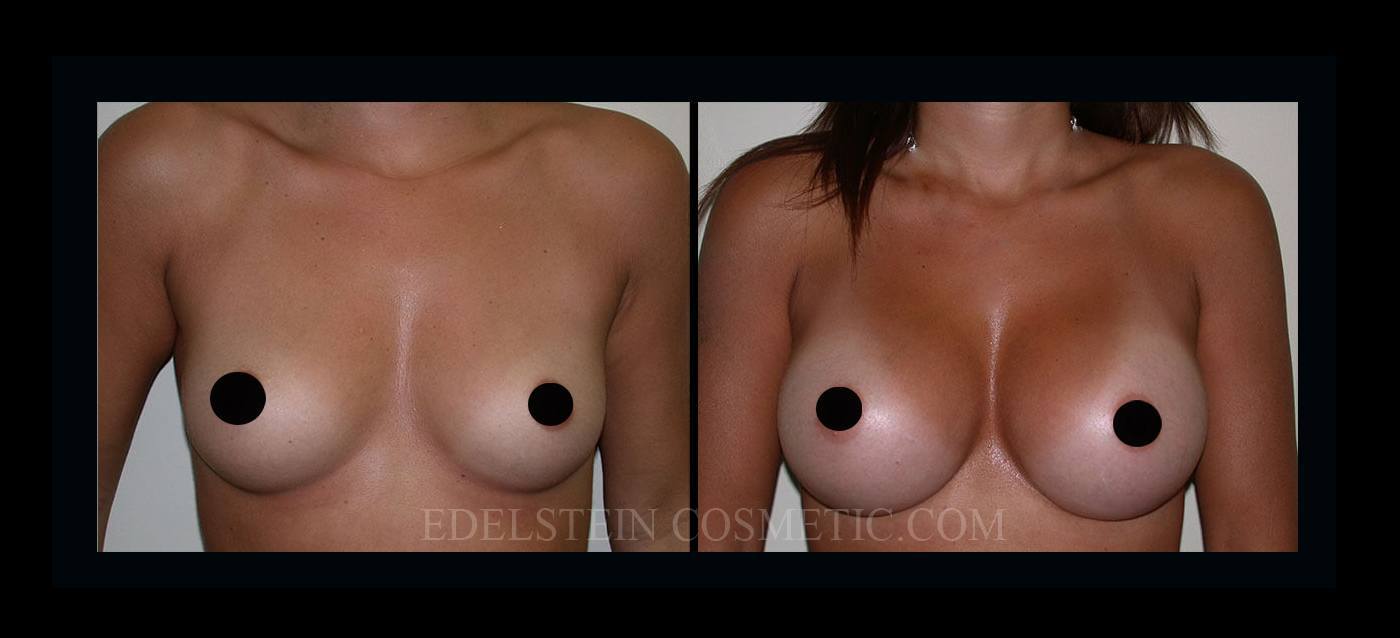 Breast Augmentation case #26852