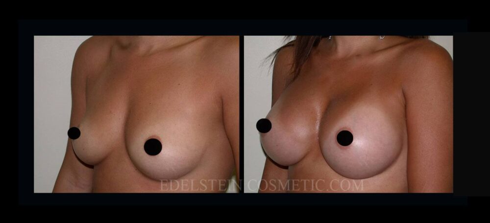 Breast Augmentation case #26852