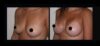 Breast Augmentation case #26852 slider thumbnail