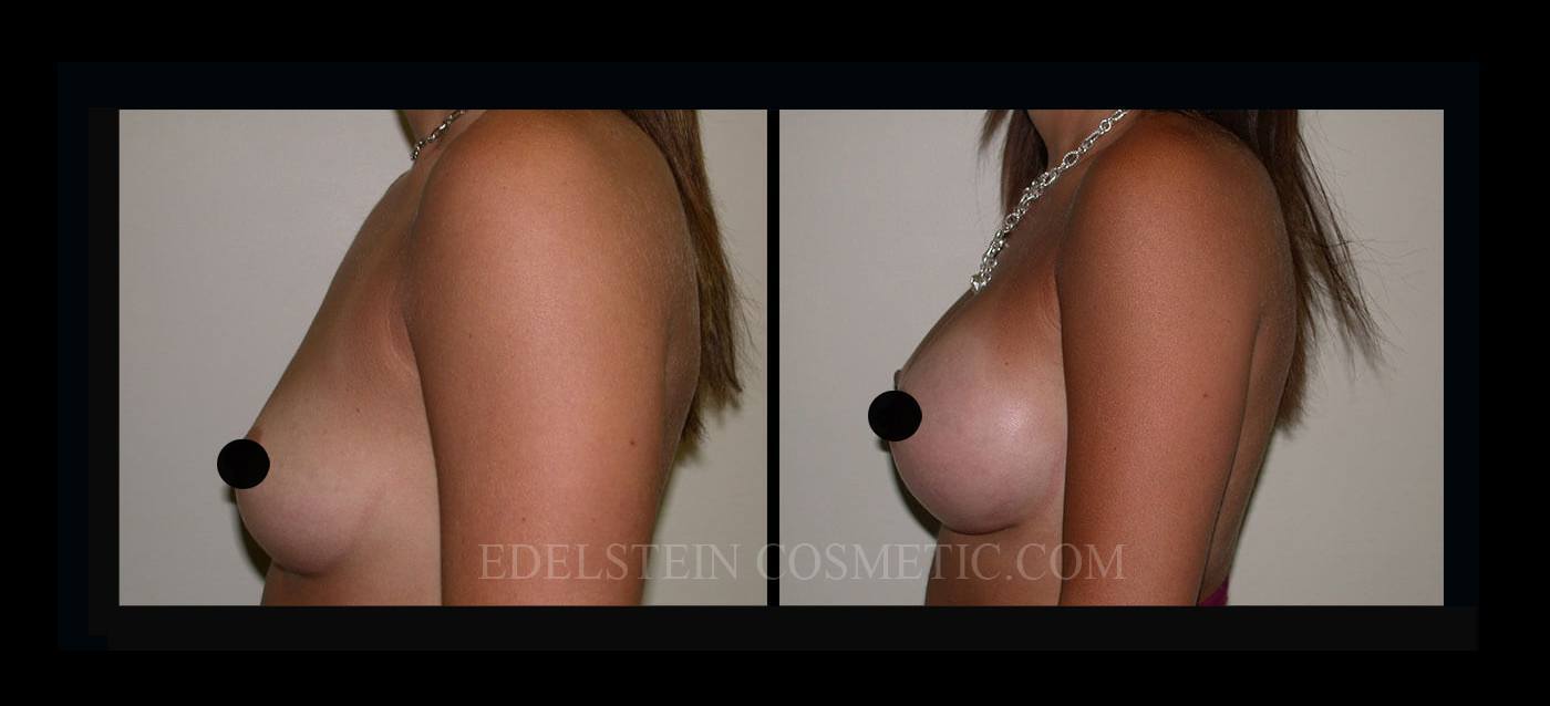 Breast Augmentation case #26852