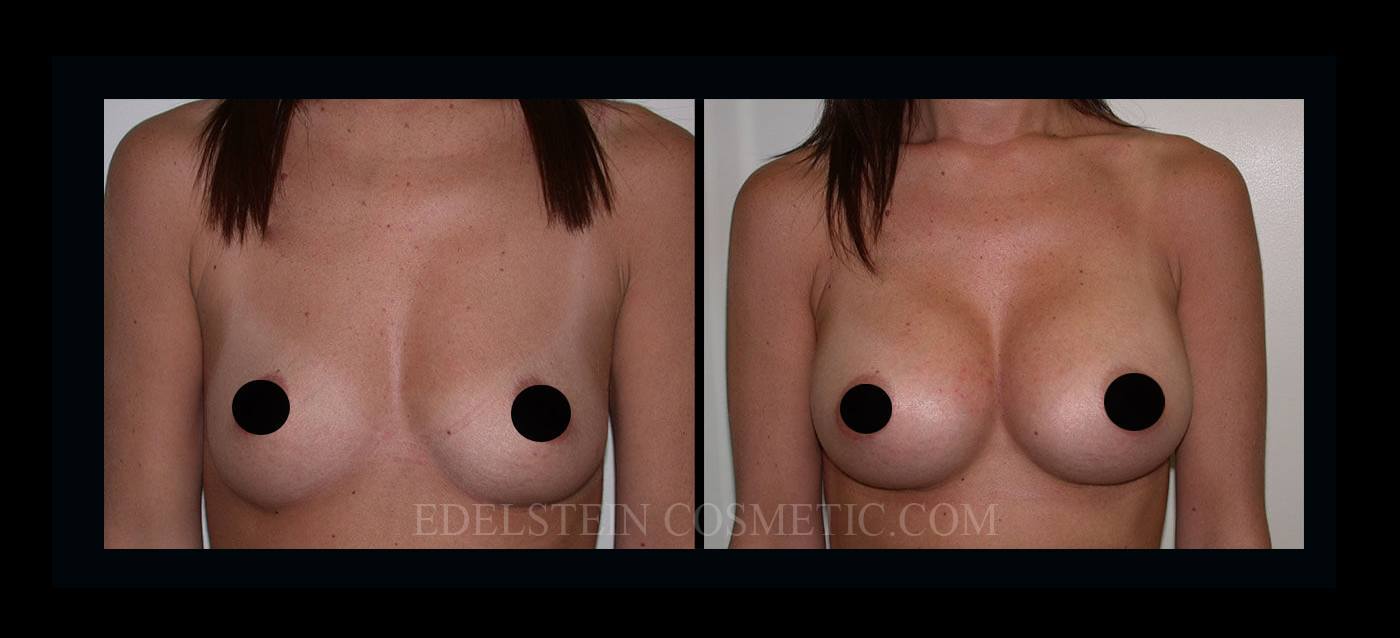 Breast Augmentation case #26851