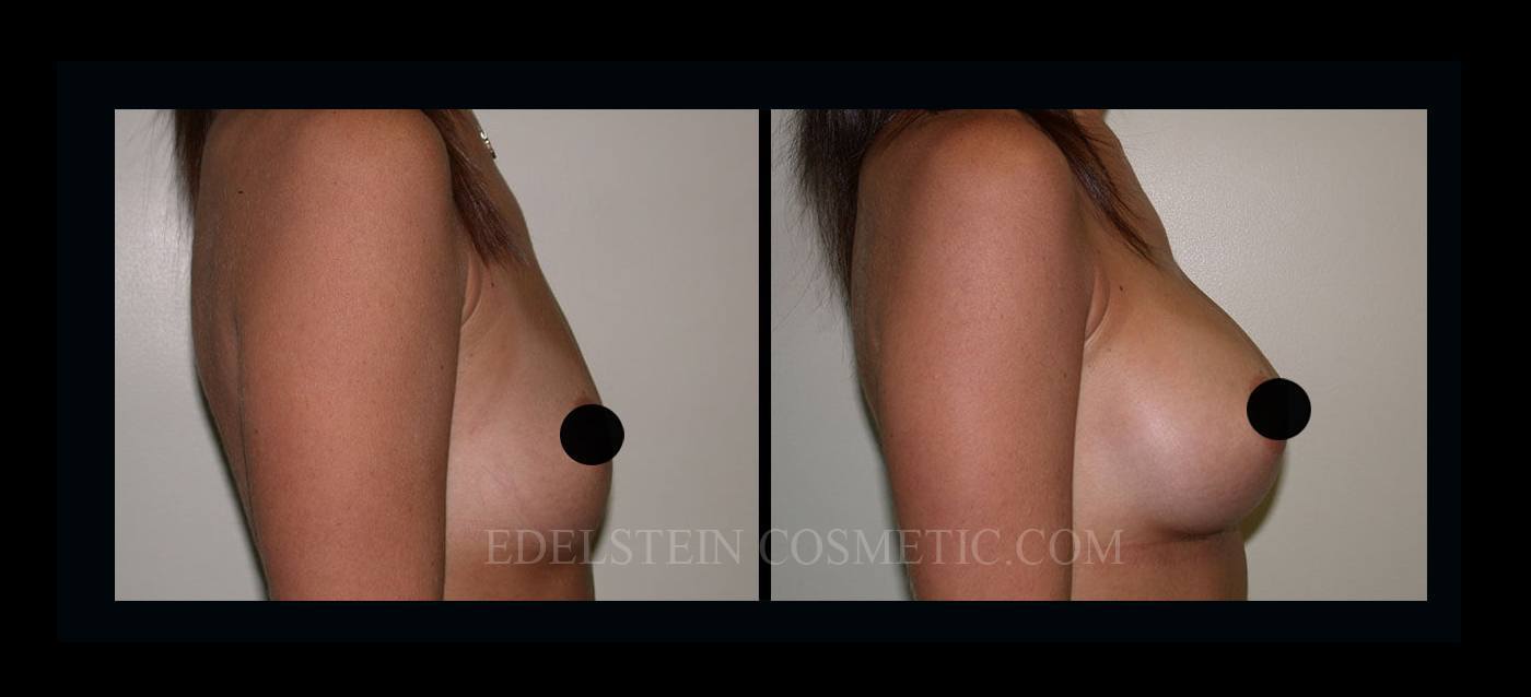 Breast Augmentation case #26851