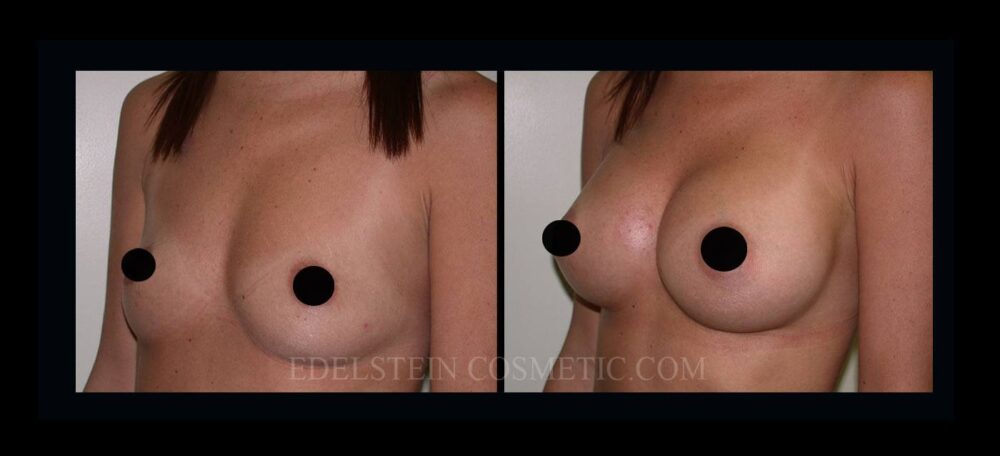 Breast Augmentation case #26851