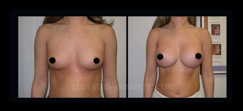 Breast Augmentation case #26850