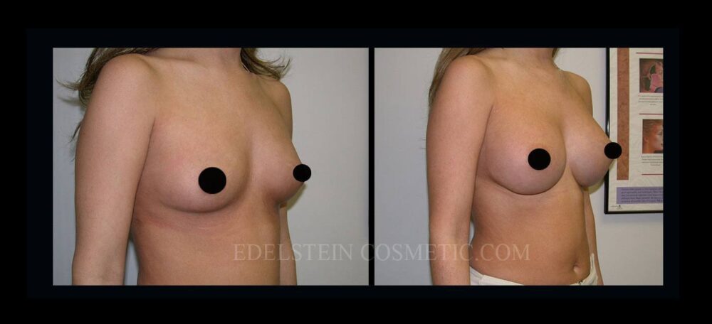 Breast Augmentation case #26850