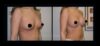 Breast Augmentation case #26850 slider thumbnail