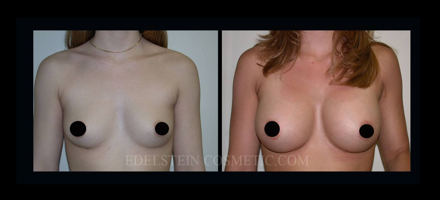 Breast Augmentation case #26849