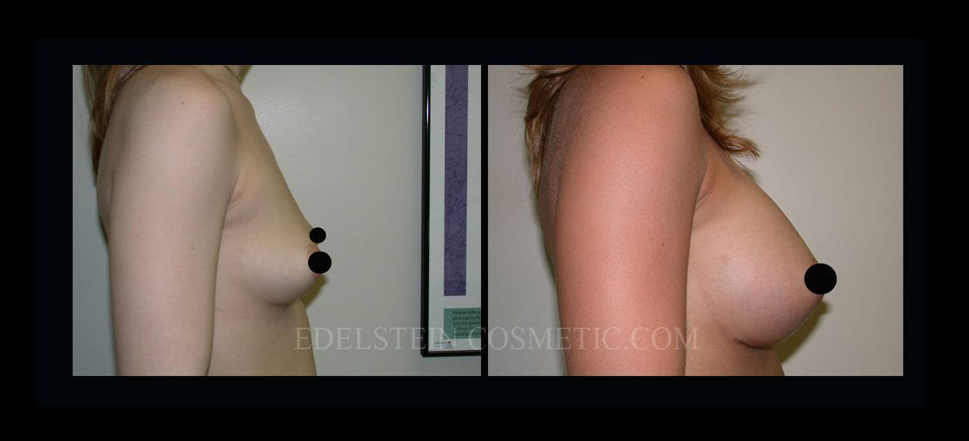 Breast Augmentation case #26849