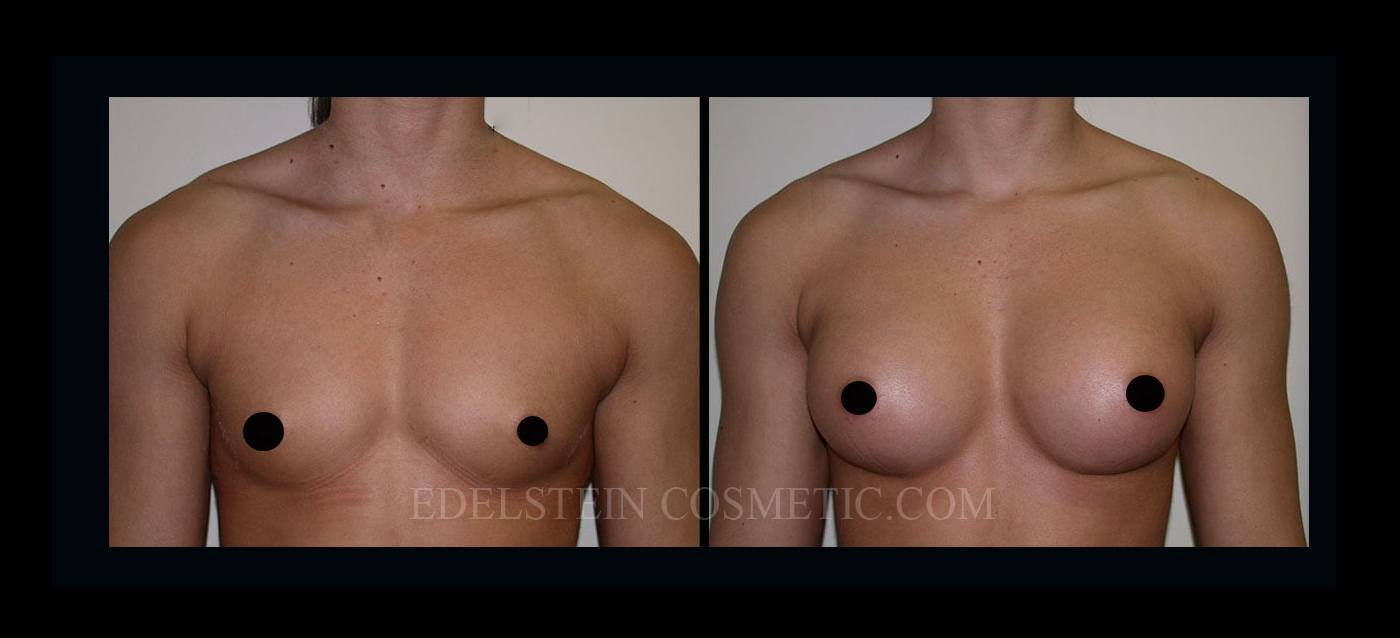 Breast Augmentation case #26848