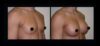 Breast Augmentation case #26848 slider thumbnail