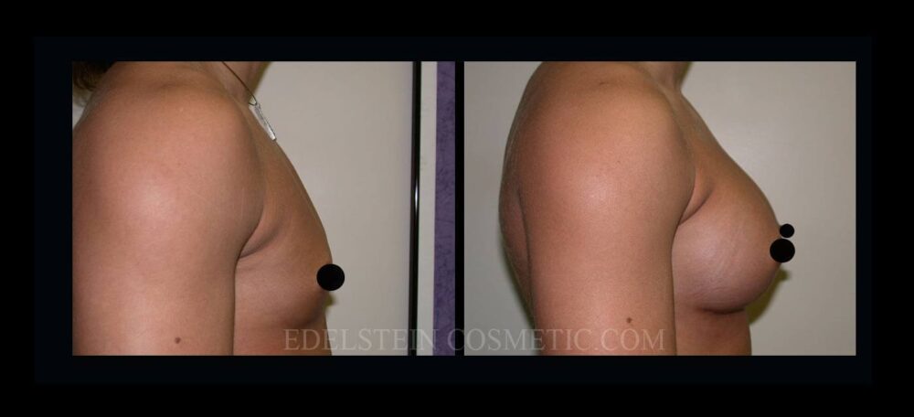 Breast Augmentation case #26848