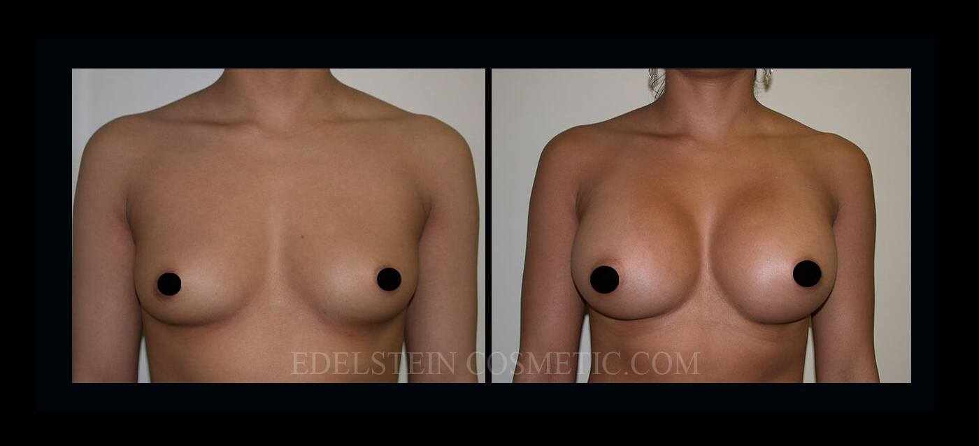 Breast Augmentation case #26847