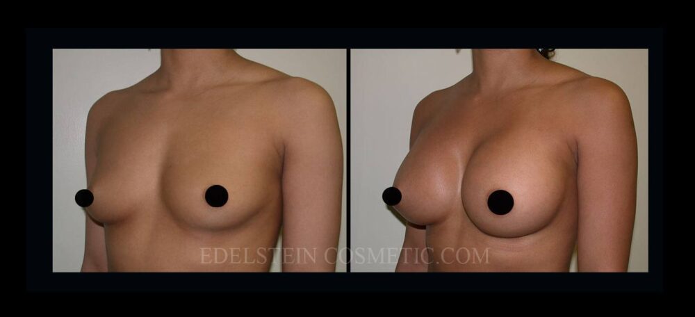 Breast Augmentation case #26847