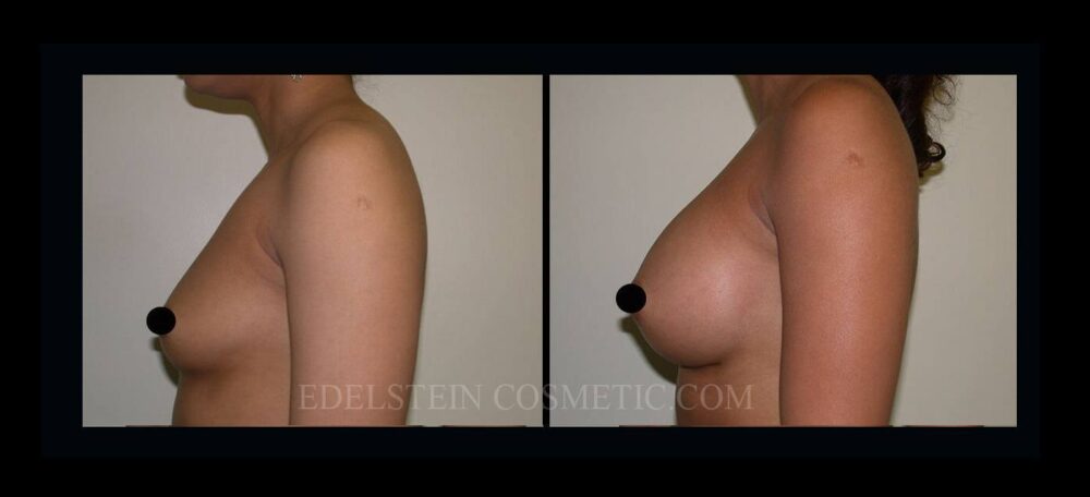 Breast Augmentation case #26847