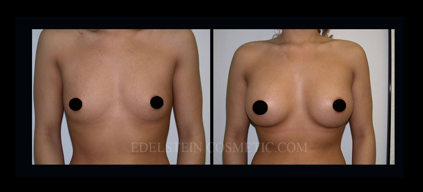 Breast Augmentation case #26846