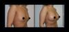 Breast Augmentation case #26846 slider thumbnail